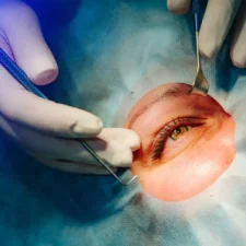 Are You Awake During LASIK